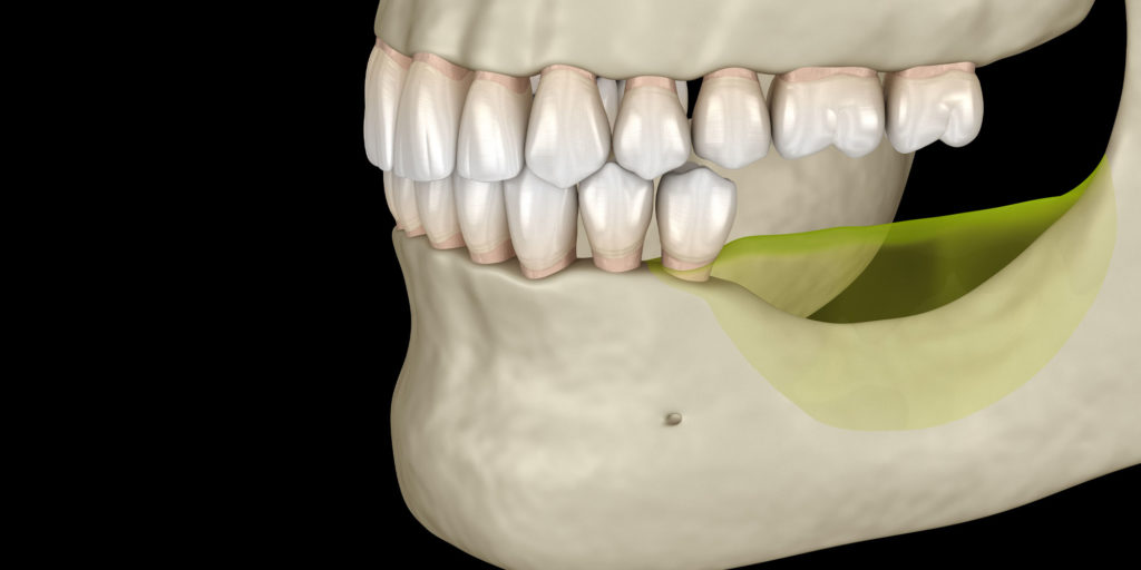 bone loss graphic