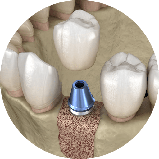 bone grafting graphic