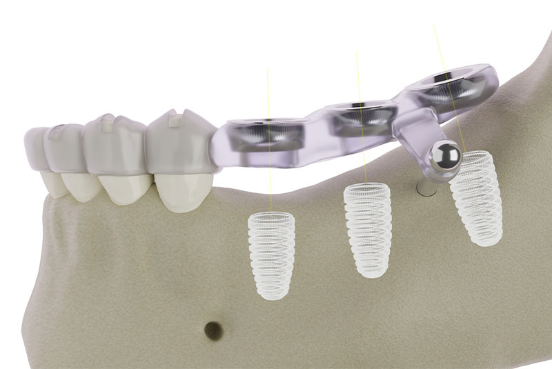 Guided Implant Surgery